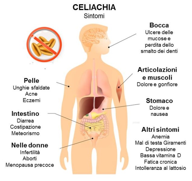La Rubrica Del Nutrizionista: La Celiachia